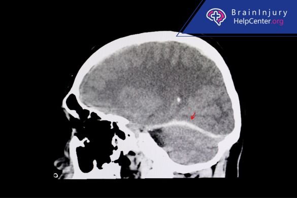 lesiones cerebrales de Chip Woodell