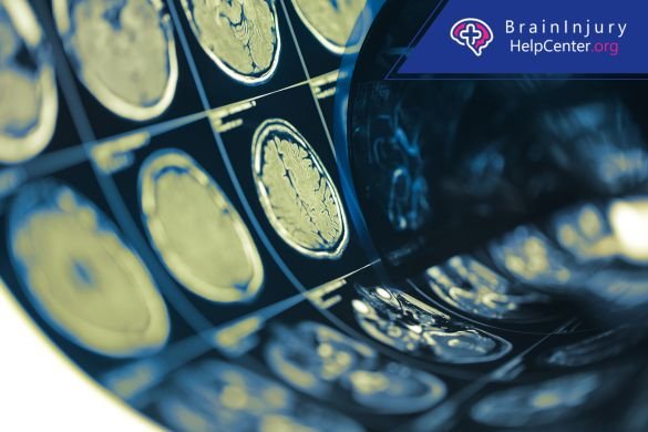 brain injury from wrongful arrest