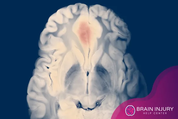 LCT después de un accidente